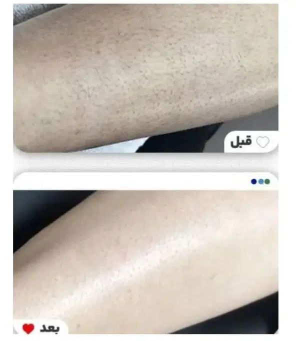 آموزش لیزر موج کندلا مرکز لیزر آقایان لیزر بانوان|خدمات آموزشی|اصفهان, شمس آباد|دیوار