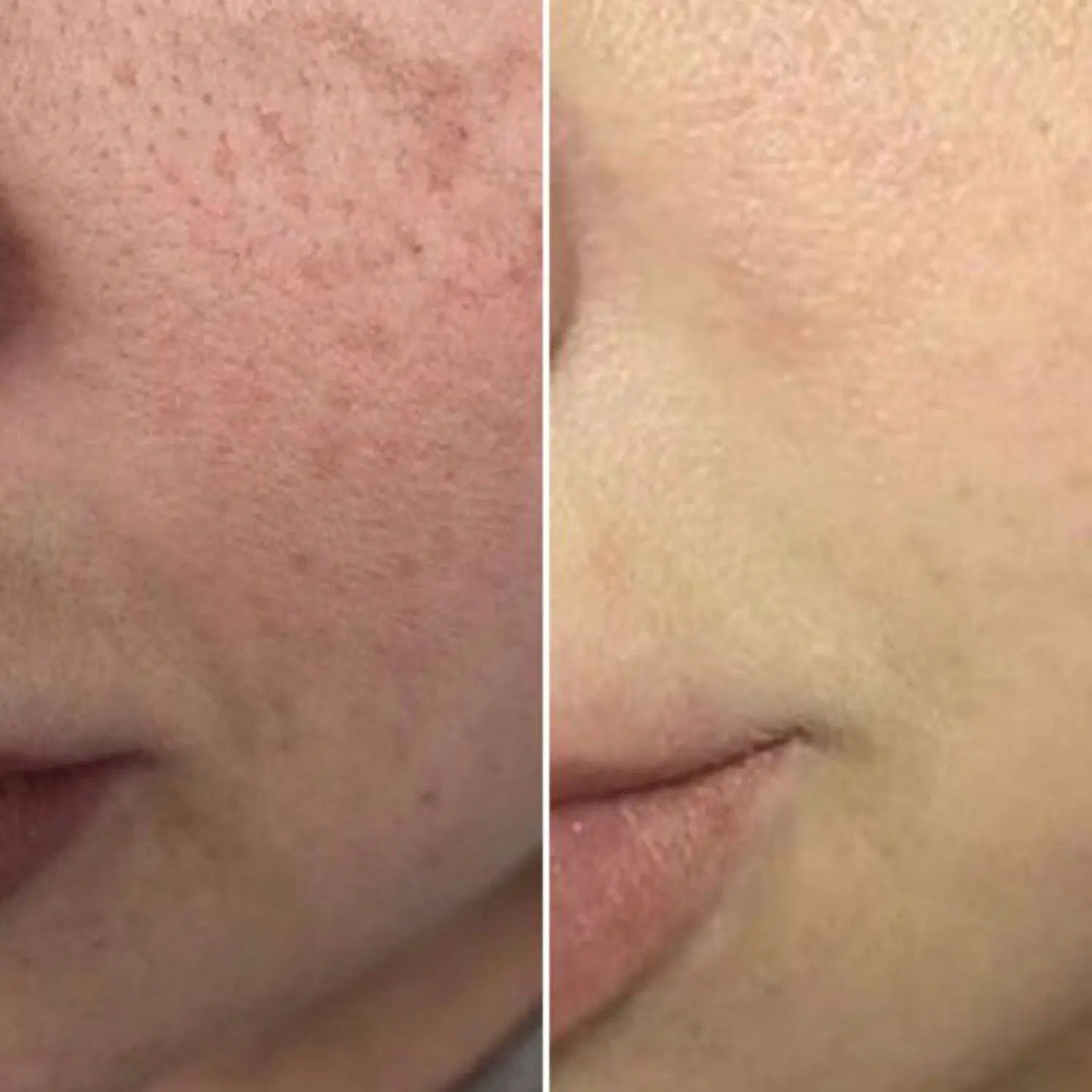 حذف لک و منافذ باز و جای جوش/زیر نظر متخصص پوست|خدمات آرایشگری و زیبایی|مشهد, الهیه|دیوار