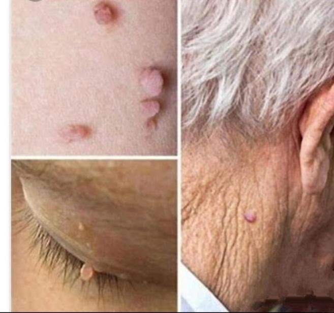 کلینیک لیزر کرایو زگیل خال میخچه حجامت زالو بوتاکس|خدمات آرایشگری و زیبایی|شیراز, حافظیه|دیوار