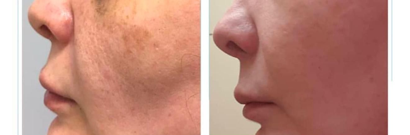 جشنوارهیلیزرCO2فرکشنال(رفعخال،ککومک،جایجوش)|خدمات آرایشگری و زیبایی|زنجان, |دیوار