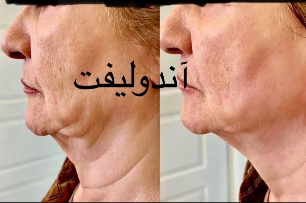 ساکشن غبغب شکم پهلو|خدمات آرایشگری و زیبایی|شیراز, عفیف‌آباد|دیوار