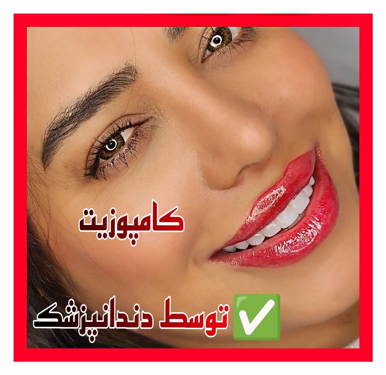 لمینیت کامپوزیت بریج و دندان مصنوعی و روکش|خدمات آرایشگری و زیبایی|تهران, آرژانتین|دیوار