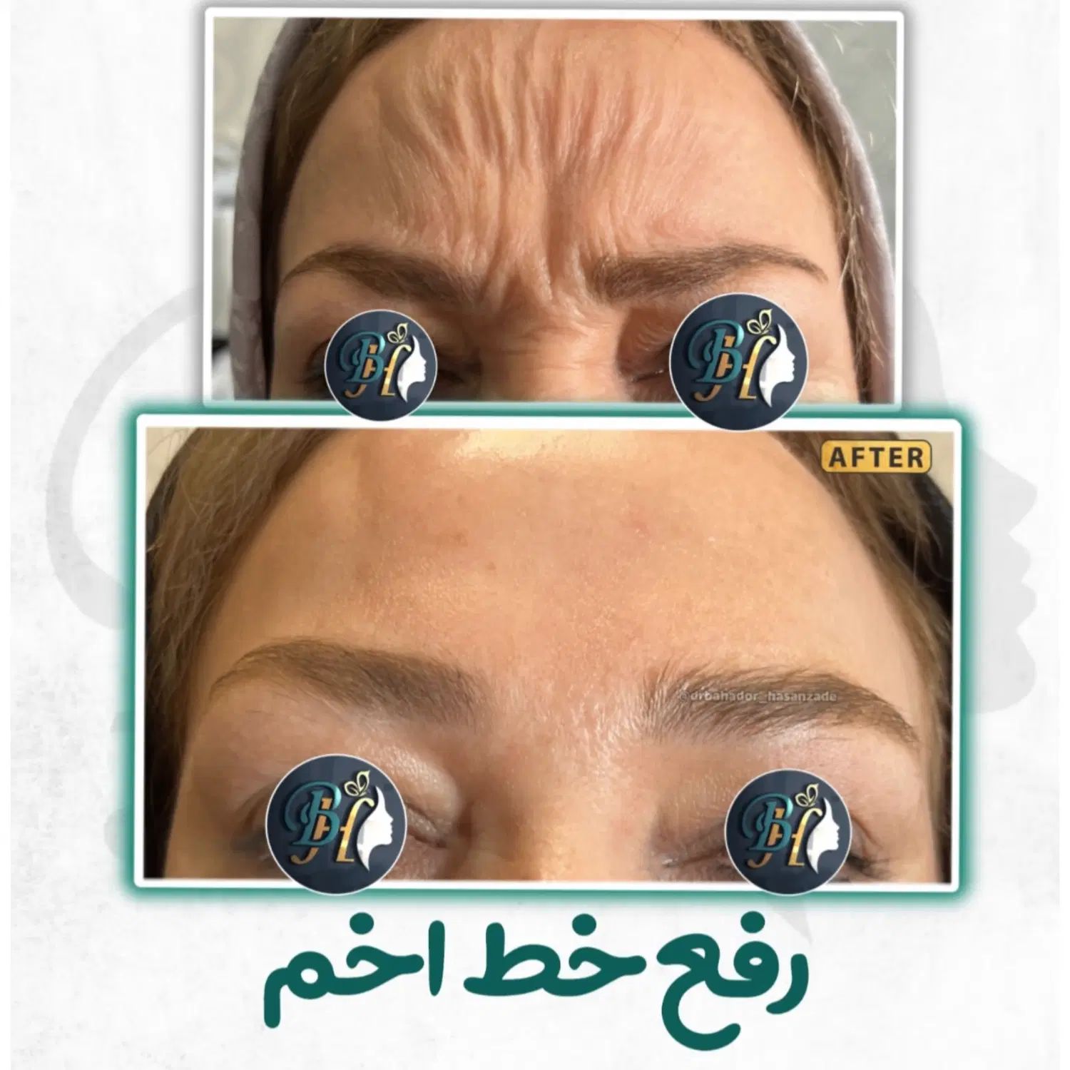 تزریق تخصصی بوتاکس صورت توسط پزشک، مطب زیبایی رشت|خدمات آرایشگری و زیبایی|رشت, گلسار|دیوار