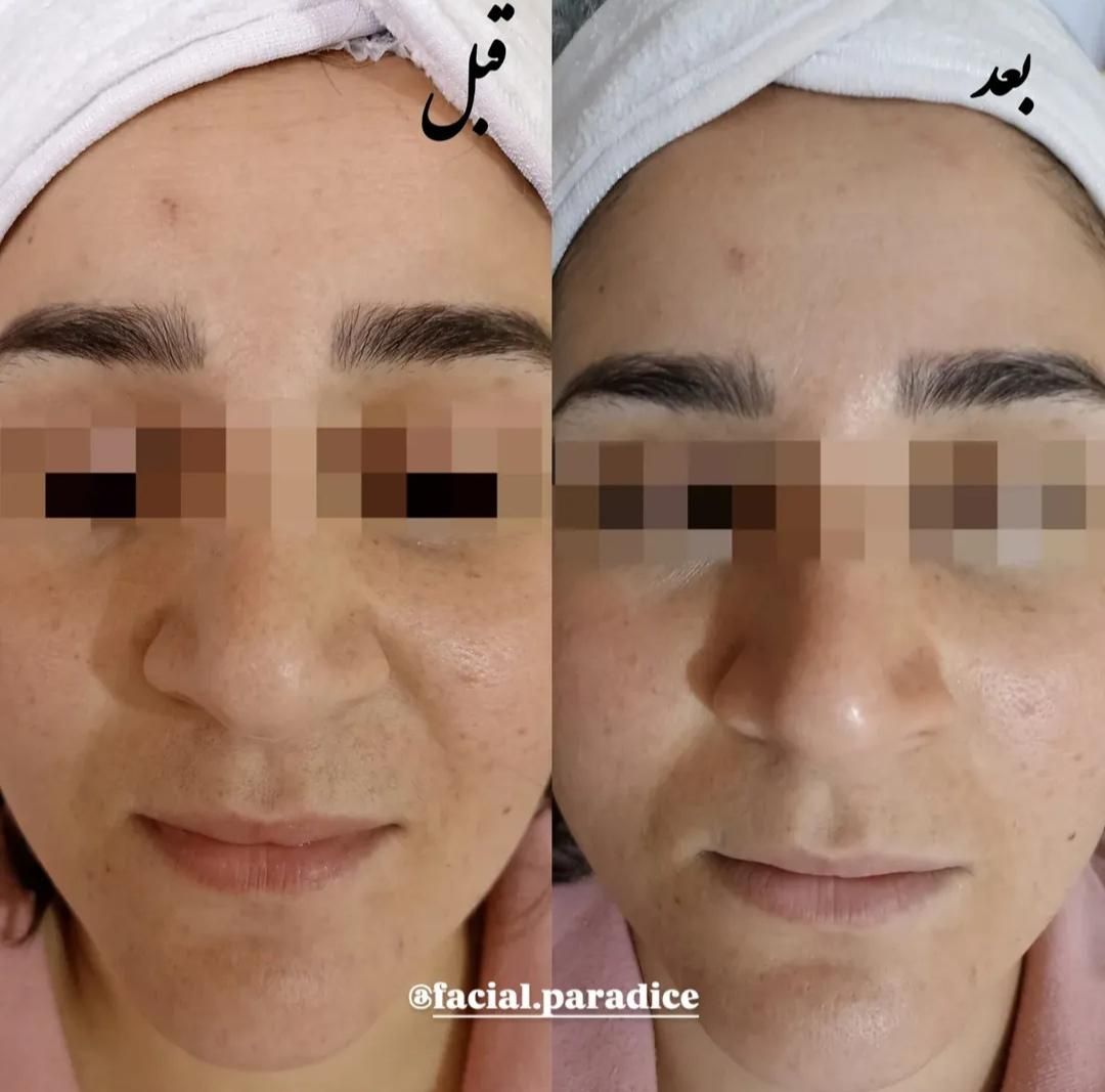 آموزش و پاکسازی و فیشیال تخصصی پوست|خدمات آرایشگری و زیبایی|مشهد, فارغ التحصیلان|دیوار