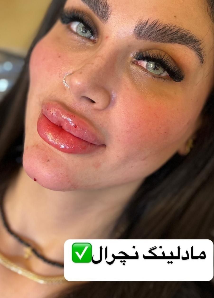 فیلر لب.بوتاکس.مزوژل.لب روسی.|خدمات آرایشگری و زیبایی|بندر انزلی, چهارفریضه|دیوار