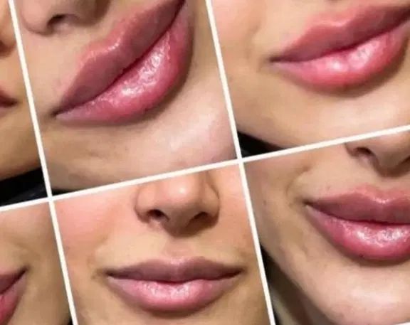 تزریق ژل،بوتاکس،پی آرپی،مزو تراپی،پلاسما جت|خدمات آرایشگری و زیبایی|بندر امام خمینی, |دیوار