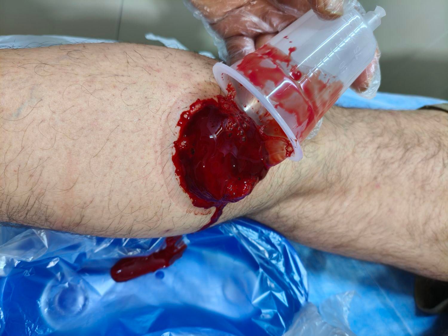 فصد پیشانی حجامت زالو درمانی|خدمات آرایشگری و زیبایی|ارومیه, |دیوار