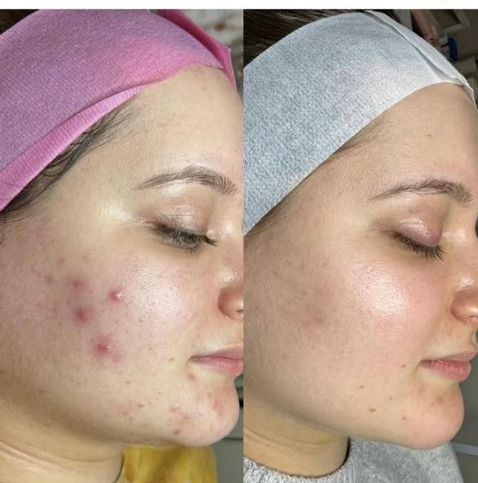 آموزش صفر تا صد پاکسازی پوست در کلینیک با مدرک فنی|خدمات آموزشی|اراک, |دیوار