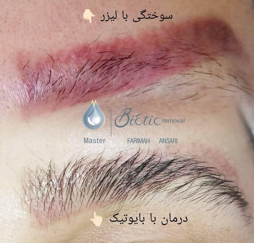 ریموو تتو یک جلسه|خدمات آرایشگری و زیبایی|اصفهان, فرح آباد|دیوار