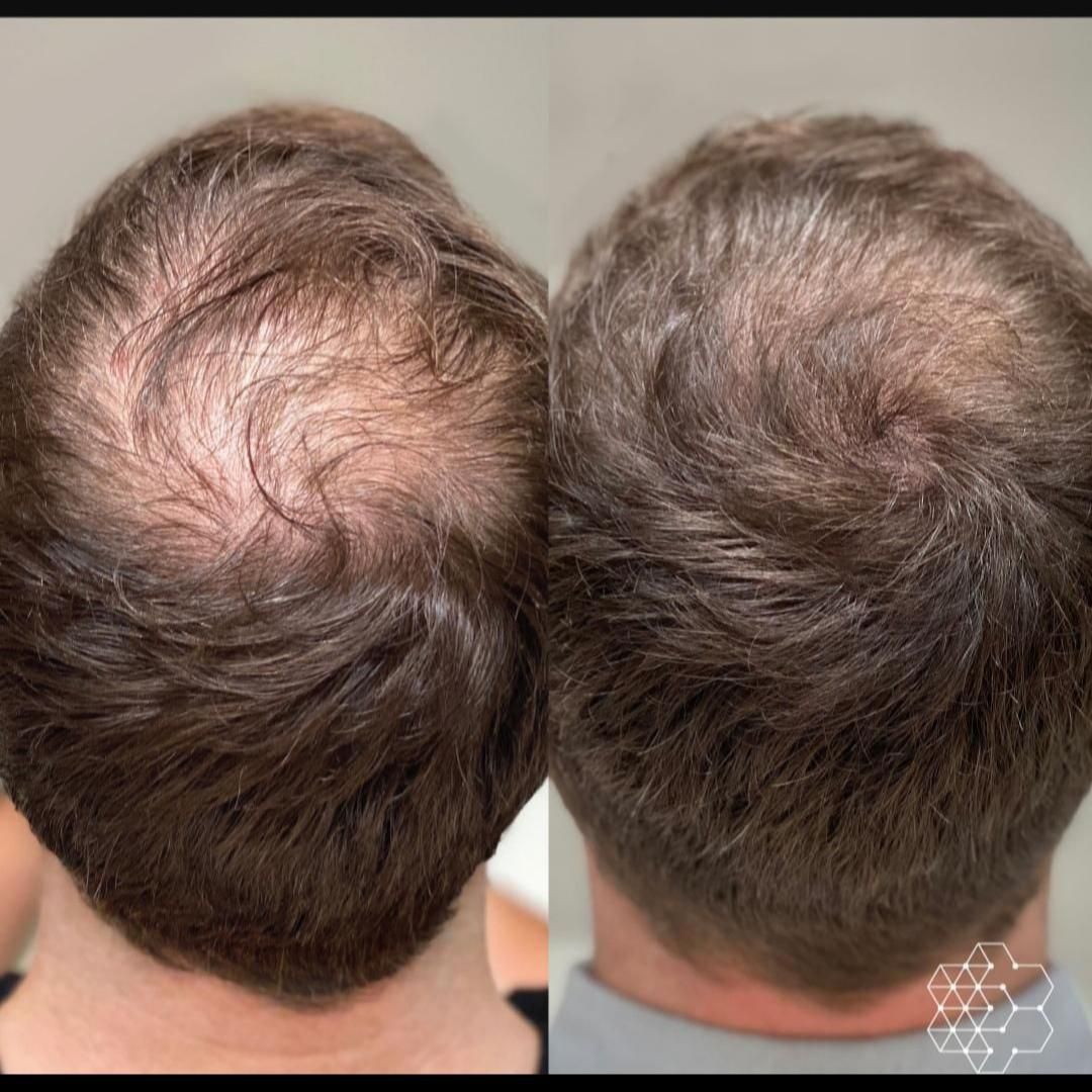 پی آر پی *بدون‌درد* prp قطع ریزش مو با ضمانت  365ت|خدمات آرایشگری و زیبایی|تبریز, |دیوار