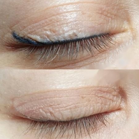 پاک کردن و ریموو تاتو صورت بدون عوارض و در یک جلسه|خدمات آرایشگری و زیبایی|تهران, دهکده المپیک|دیوار