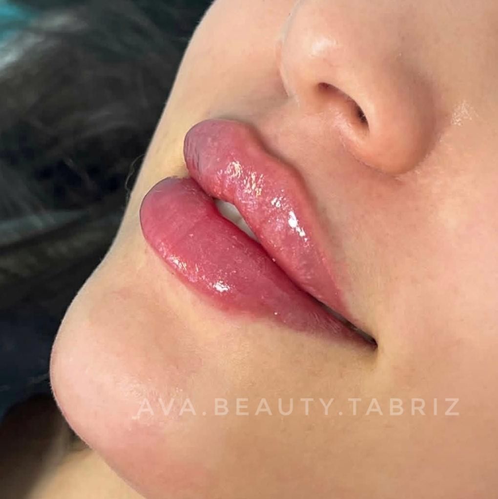 تزریق تخصصی فیلرلب بدون درد و باتضمین|خدمات آرایشگری و زیبایی|تبریز, |دیوار
