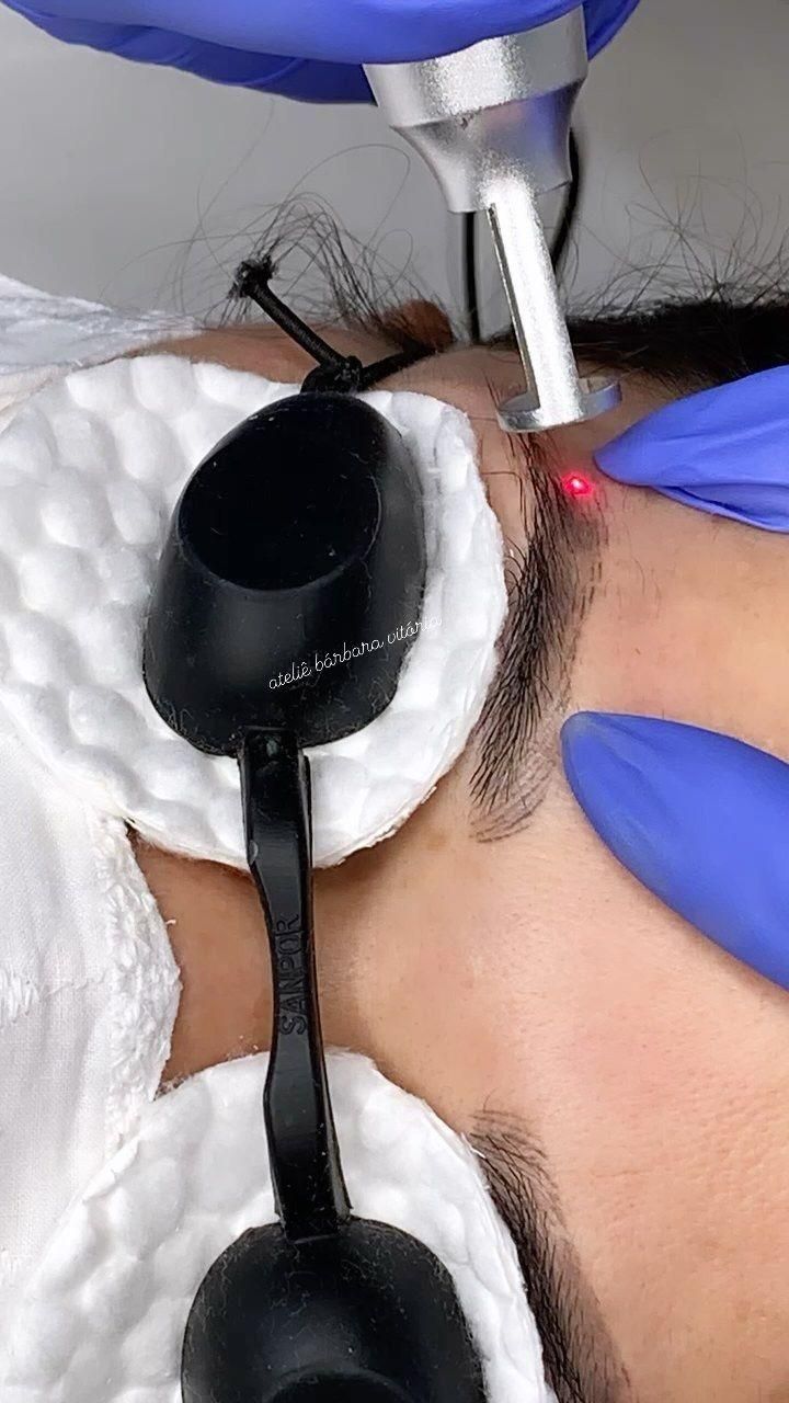 پاک کردن تتو ابرو و بدن با دستگاه لیزر پیکوشور|خدمات آرایشگری و زیبایی|ارومیه, |دیوار