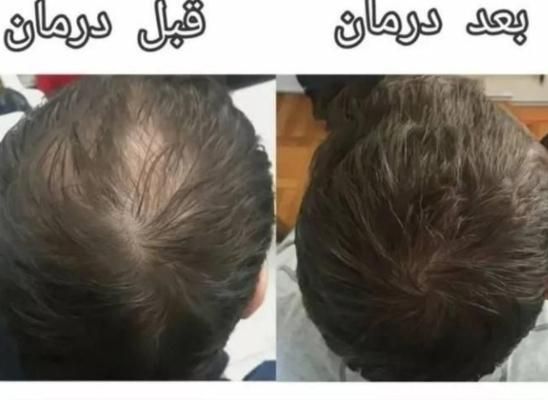 رویش مو (پی ارپی ، مزوتراپی )|خدمات آرایشگری و زیبایی|اهواز, پادادشهر|دیوار