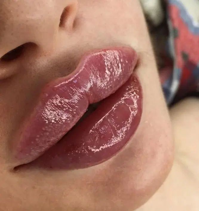 تزریق ژل لب فیلر زاویه سازی صورت فک گونه بوتاکس|خدمات آرایشگری و زیبایی|فردیس, خیام شرقی|دیوار