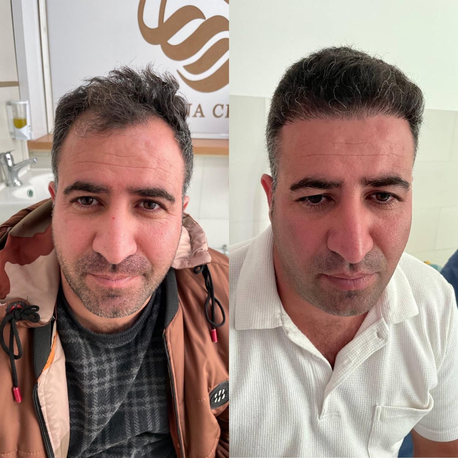 جشنواره کاشت مو ریش و ابرو|خدمات آرایشگری و زیبایی|اردبیل, |دیوار