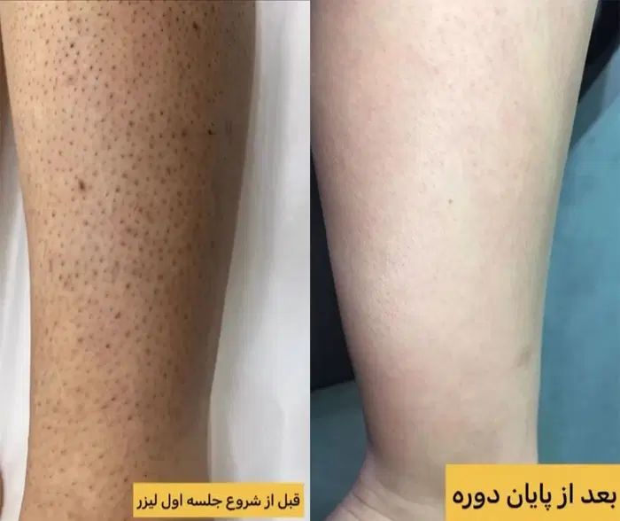 لیزر فول بادی ۶۱۰ تومان قیمت ویژه در مهلت محدود|خدمات آرایشگری و زیبایی|شهریار, شهرک وائین|دیوار