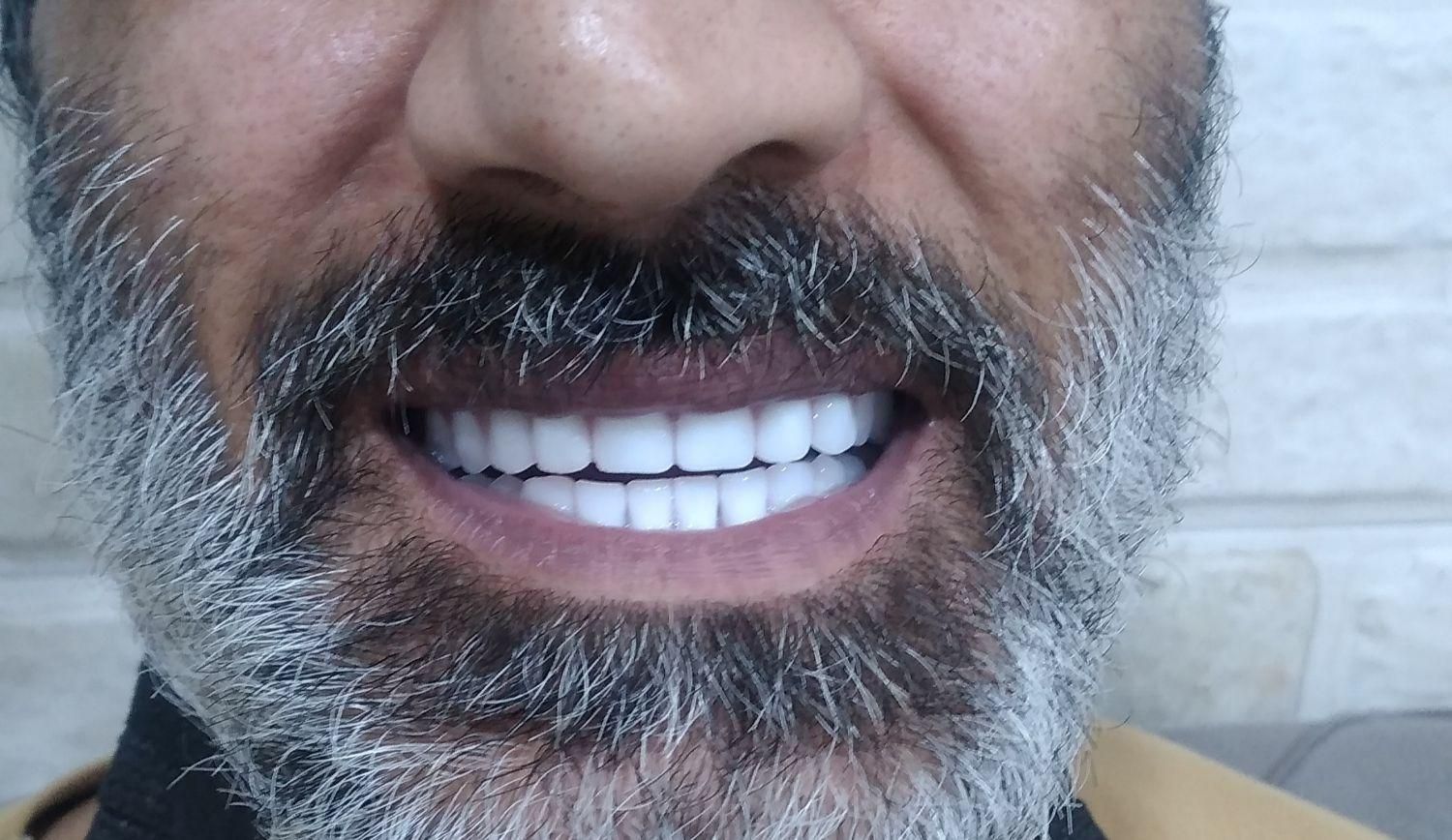 جشنواره مرکزدست دندان وساخت دندانهای مصنوعی ژلهای|خدمات آرایشگری و زیبایی|کرج, مطهری|دیوار