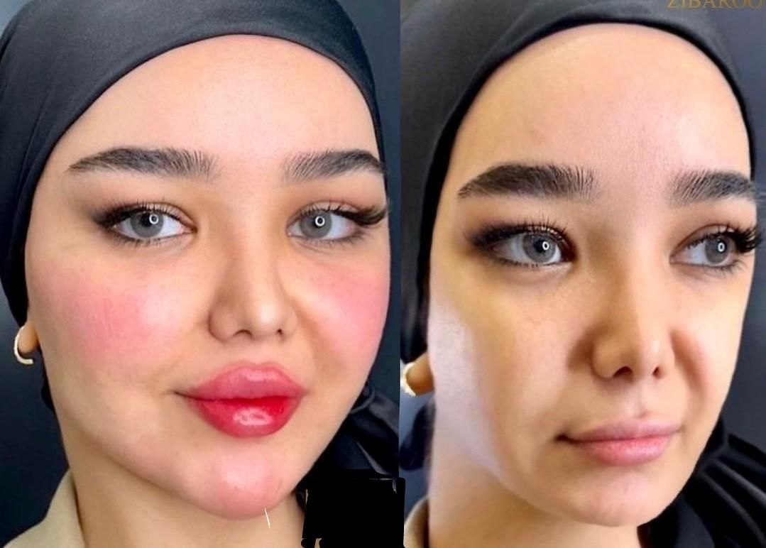 بوتاکس لیبل دار واحدی ۲۰۰ ژل اورجینال توسط پزشک|خدمات آرایشگری و زیبایی|اصفهان, احمدآباد|دیوار