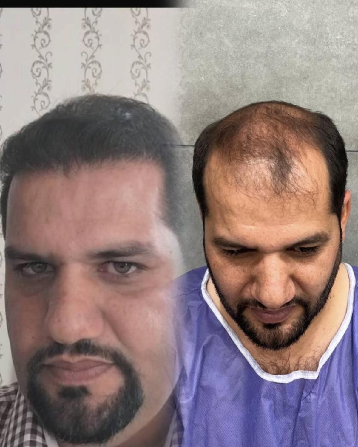 کاشت مو تضمینی در یک جلسه با تکنیک شیرازی|خدمات آرایشگری و زیبایی|یزد, |دیوار