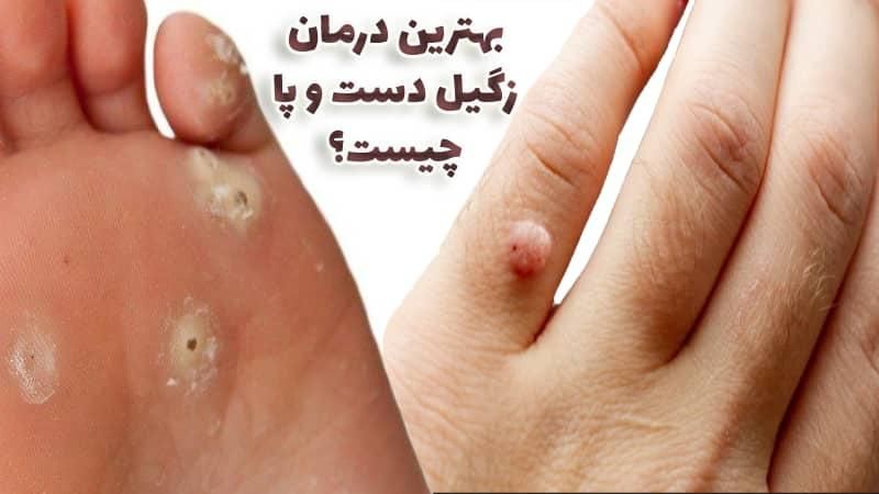 درمان قطعی خال های پوستی ،میخچه و زگیل|خدمات آرایشگری و زیبایی|رفسنجان, |دیوار