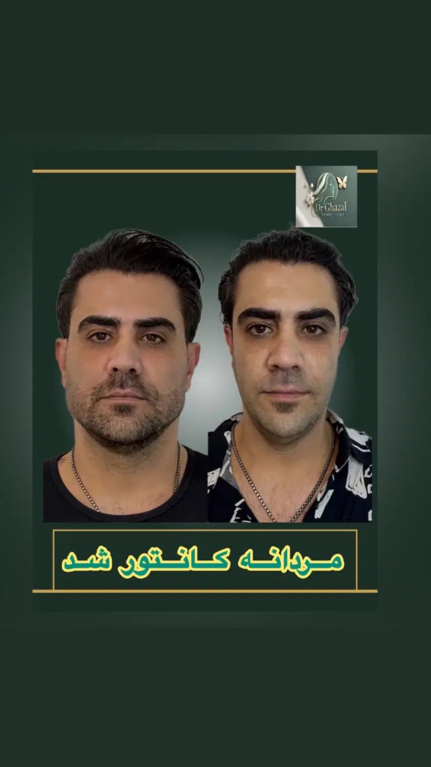 مدل خانم یااقا خوش چهره جهت تزریق فیلرو کانتورینگ|خدمات آرایشگری و زیبایی|تهران, فاطمی|دیوار