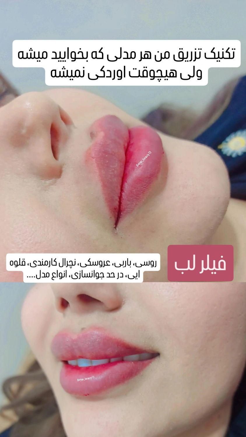 آموزش تزریق ژل بوتاکس و...|خدمات آموزشی|خرم‌آباد, |دیوار