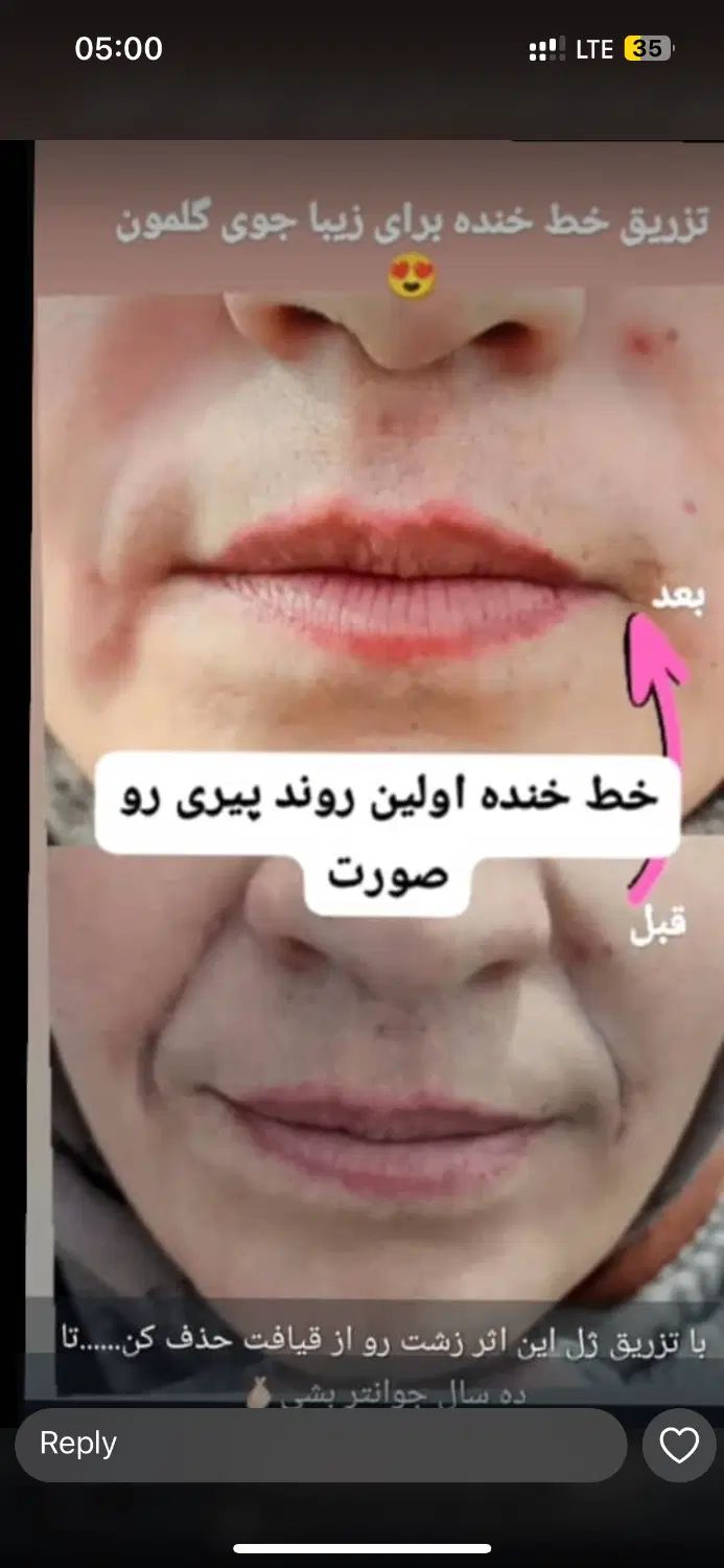 اف تابستانه زیبایی تزریق ژل، بوتاکس، پی ار پی|خدمات آرایشگری و زیبایی|اهواز, کمپلو جنوبی|دیوار
