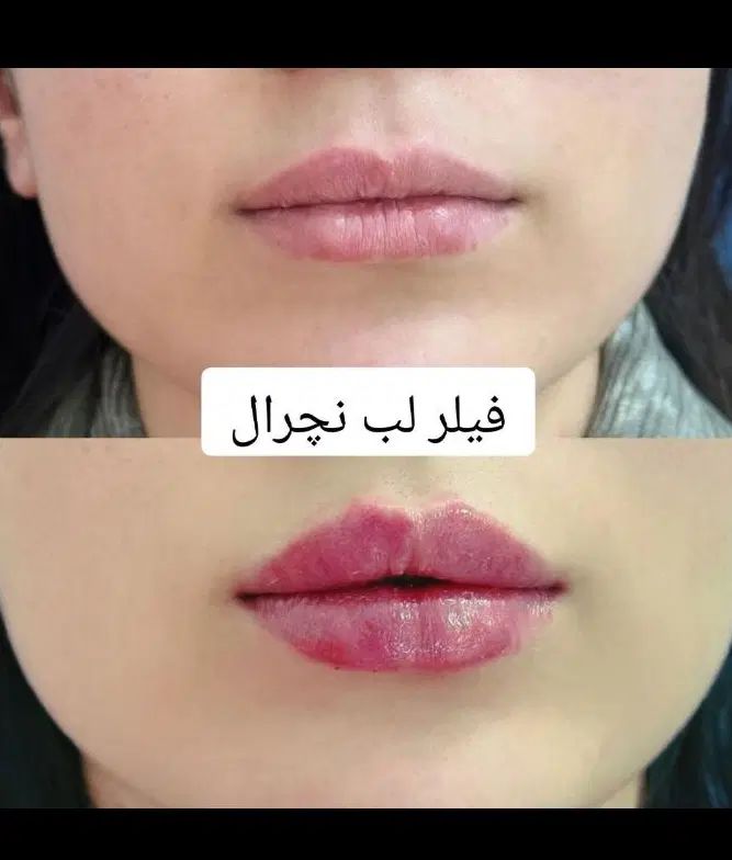 جشنواره بوتاکس/فیلر/مزوتراپی/پی آر پی  توسط پزشک|خدمات آرایشگری و زیبایی|زنجان, |دیوار