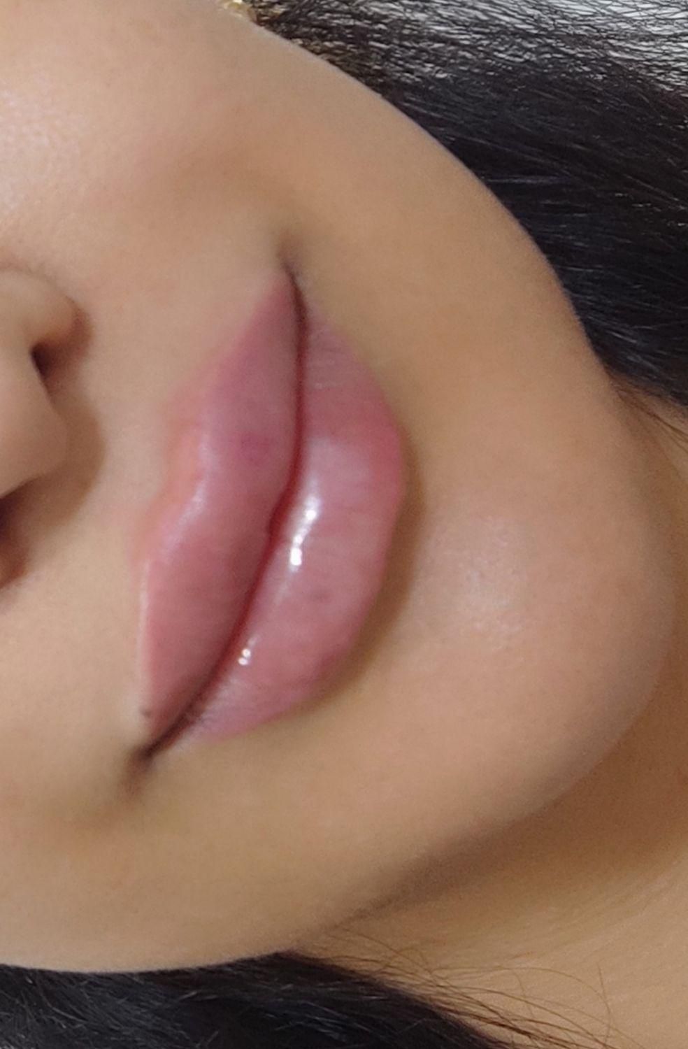 ژل و بوتاکس|خدمات آرایشگری و زیبایی|جیرفت, |دیوار