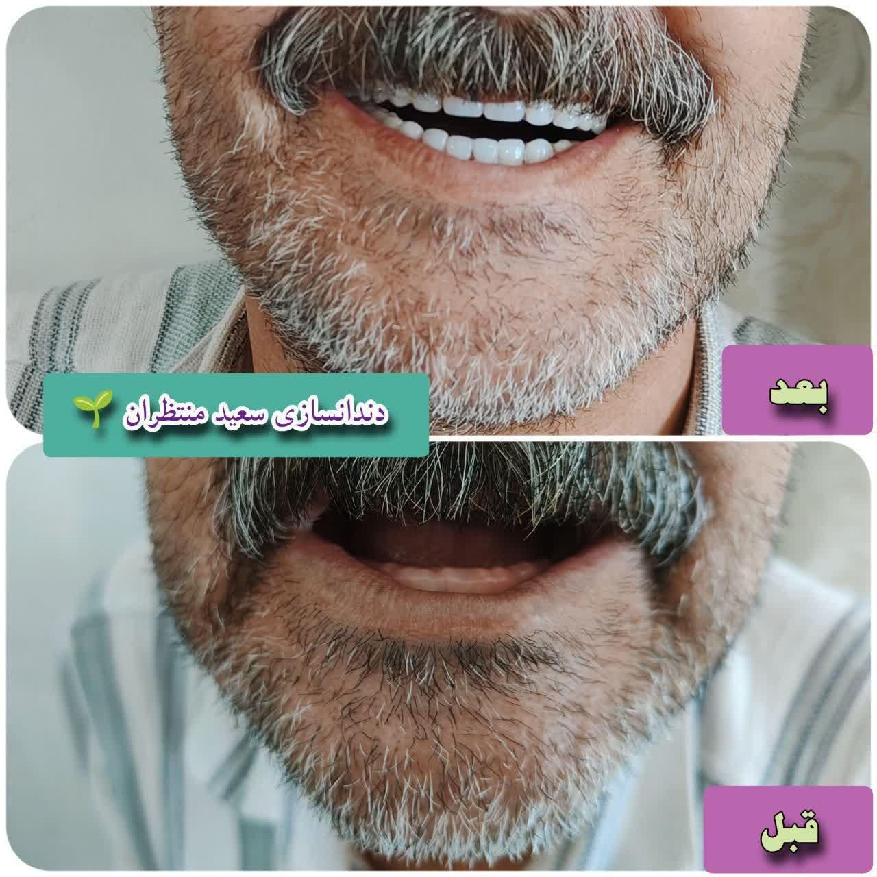 دندان مصنوعی/ ضمانتی / ایتالیایی/ جوان پسند|خدمات آرایشگری و زیبایی|مشهد, امام رضا (ع)|دیوار