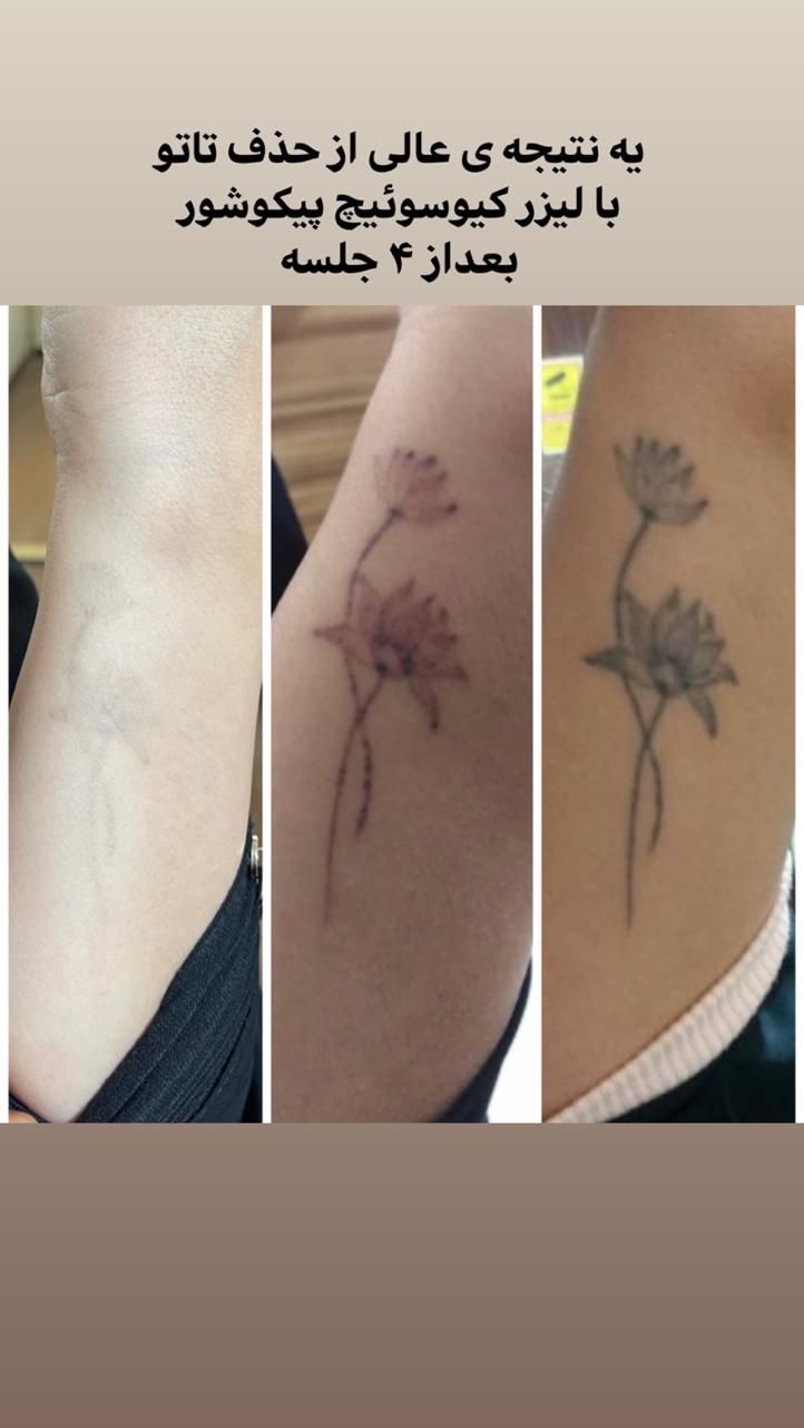 حذف تتو ابرو و بدن،کربن ترابی با لیزر در مطب|خدمات آرایشگری و زیبایی|شاهینشهر, فردوسی|دیوار