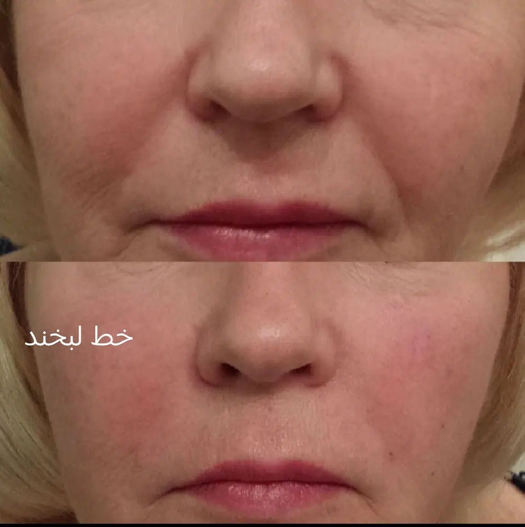 تزریق ژل .بوتاکس .انزیم بینی .مزوژل جوانساز|خدمات آرایشگری و زیبایی|جهرم, |دیوار