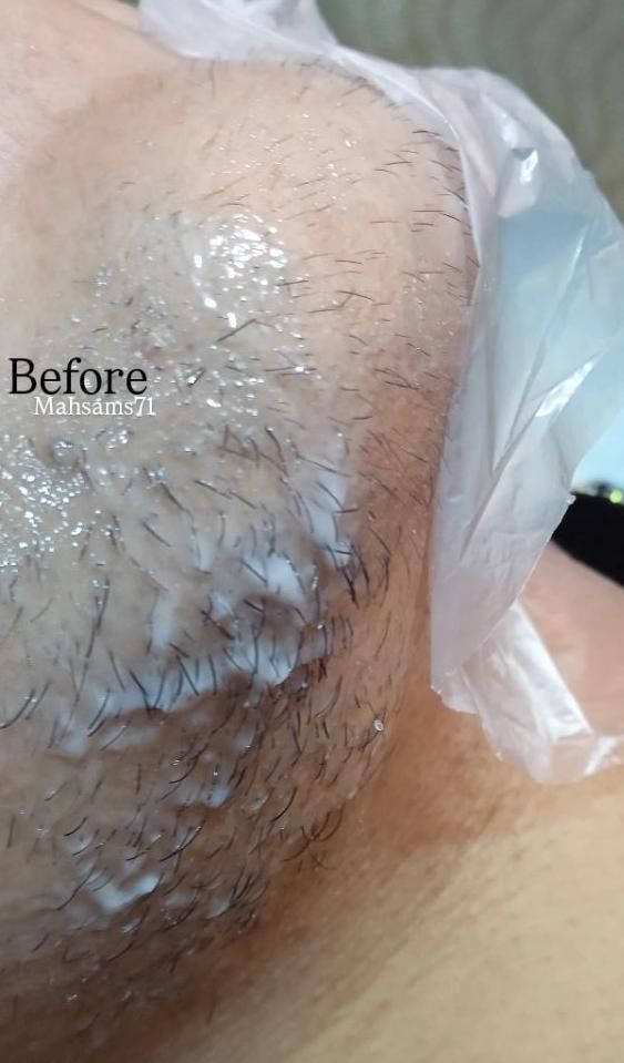خدمات و آموزش فیشیال و الکترولیز موی زائد|خدمات آرایشگری و زیبایی|بندرعباس, |دیوار