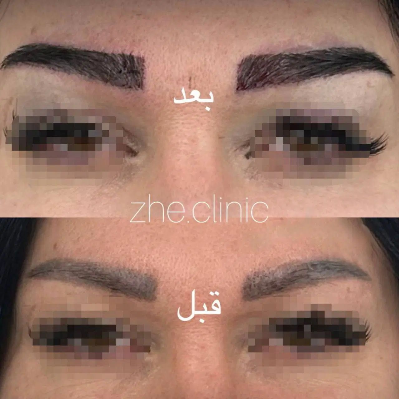 کاشت ابرو فقط ۱۴۹۰۰ با دو جلسه مزو رایگان|خدمات آرایشگری و زیبایی|مشهد, طلاب|دیوار