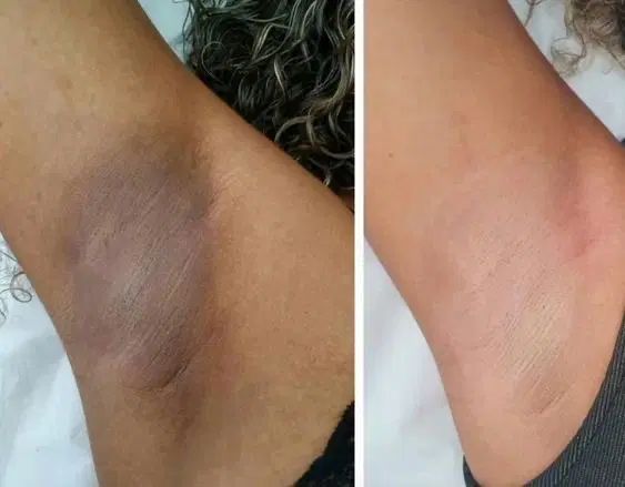 خدمات لیزر و رفع تیرگی و لاغری باتخفیف ویژه|خدمات آرایشگری و زیبایی|بجنورد, |دیوار