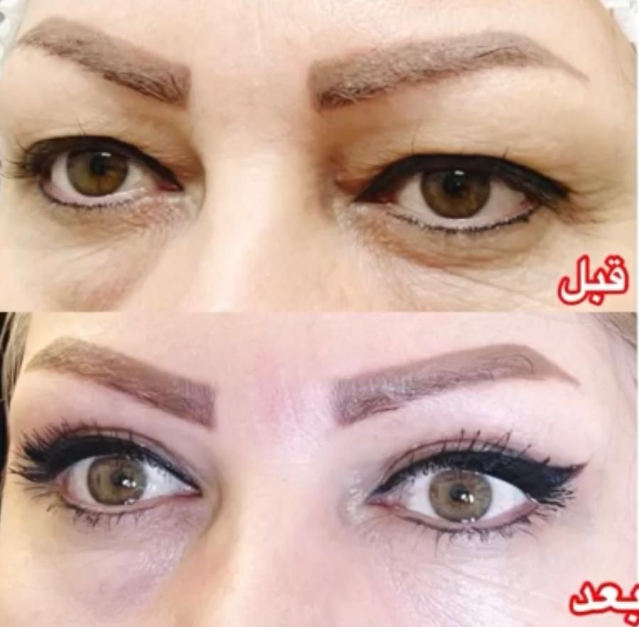 عمل بلفاروپلاستی درمان افتادگی پلک توسط متخصص چشم|خدمات آرایشگری و زیبایی|یاسوج, |دیوار