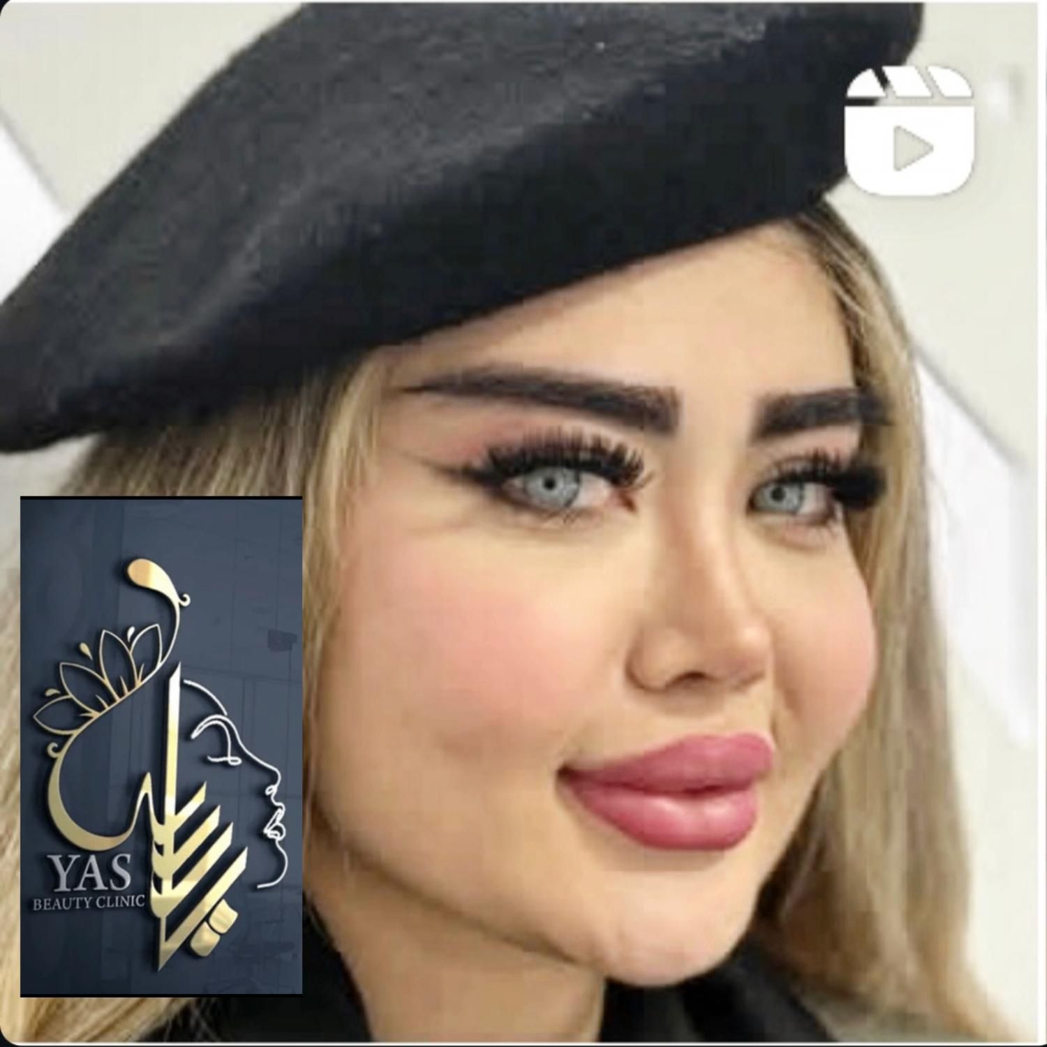 تزریق ژل وبوتاکس ومادلینگ اروپایی وهایفو درکلینیک|خدمات آرایشگری و زیبایی|کرمانشاه, |دیوار