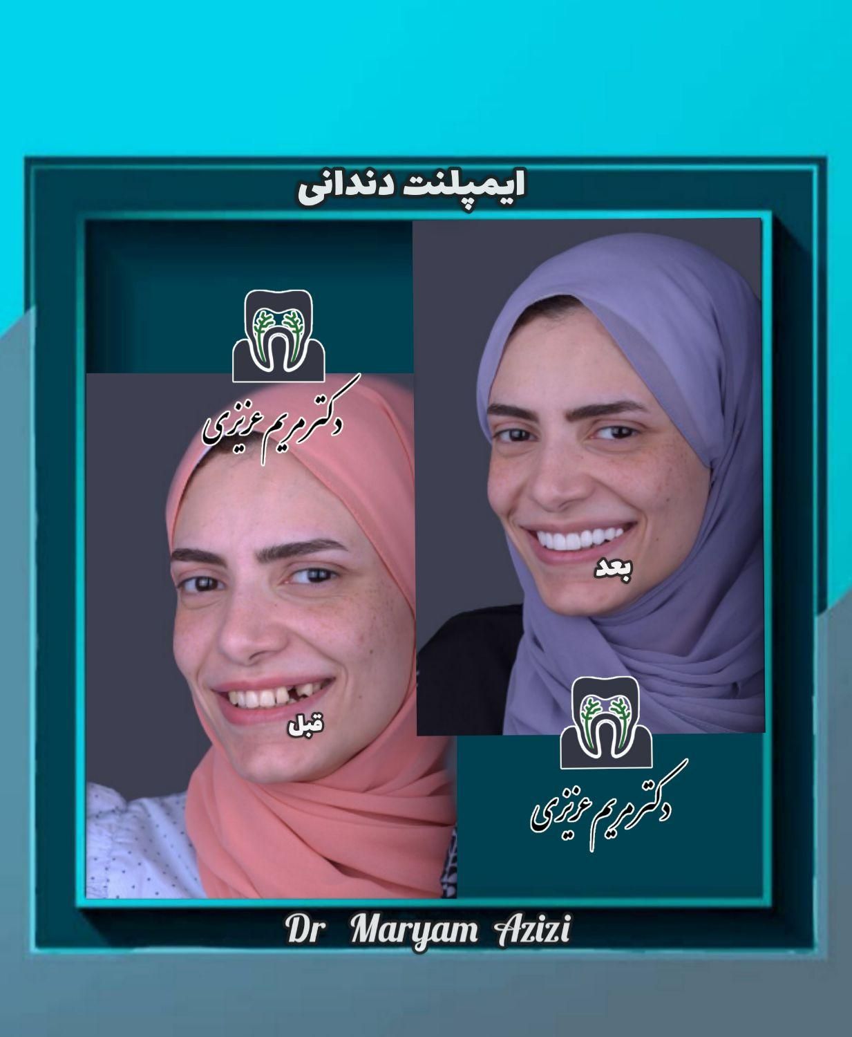پایتخت ایمپلنت دندان دندانپزشکی تضمینی تعرفه دولتی|خدمات آرایشگری و زیبایی|شیراز, معالی‌آباد|دیوار