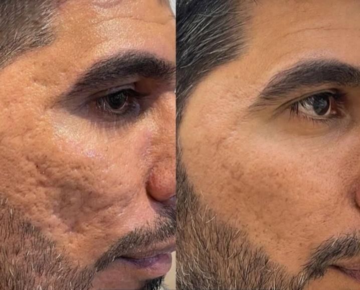 انجام کلیه خدمات پاکسازی پوست بصورت کاملا تخصصی|خدمات آرایشگری و زیبایی|سرپل ذهاب, |دیوار