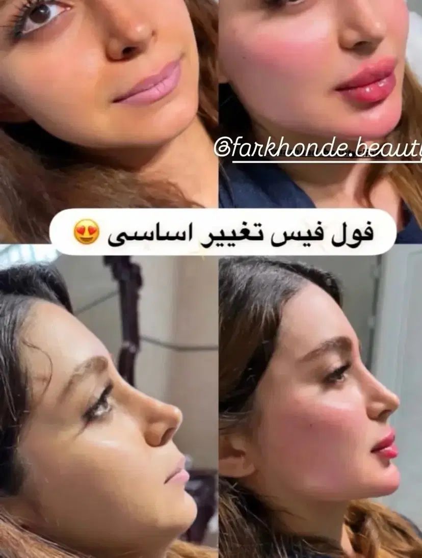 جشنواره ویژه فیلر لب فول فیس زاویه فک،گونه،چونه و.|خدمات آرایشگری و زیبایی|مشهد, شهید فرامرز عباسی|دیوار