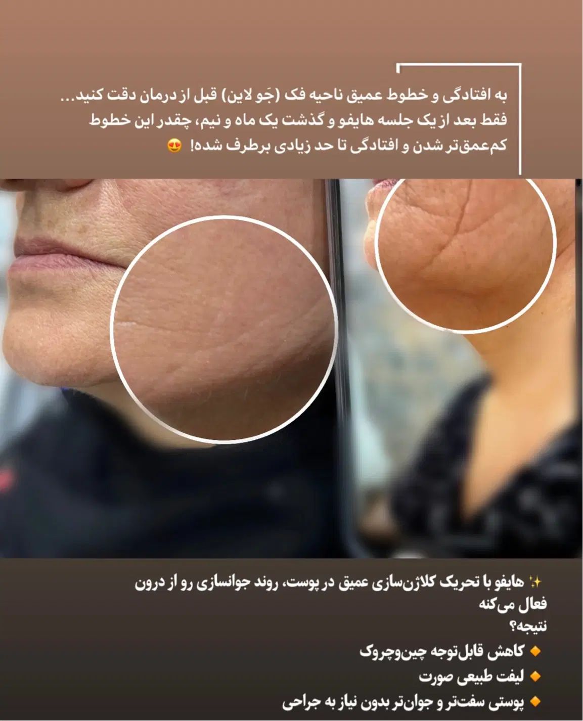 جوانسازی‌ولیفت‌صورت‌باهایفورفع‌تیرگی‌لک‌وتتوبالیزر|خدمات آرایشگری و زیبایی|مهاباد (آذربایجان غربی), |دیوار