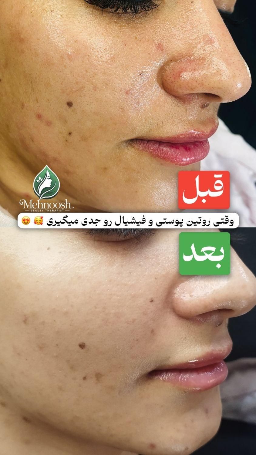 فیشیال تخصصی پوست،همراه اشانتیون ویژه|خدمات آرایشگری و زیبایی|اصفهان, شهریار|دیوار