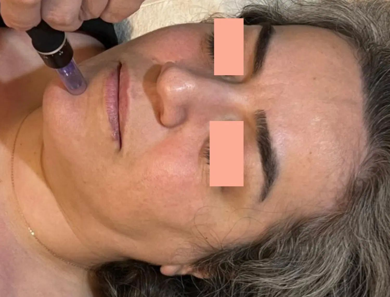 مزونیدلینگ صورت(جوان‌سازی،برطرف کردن جای جوش و لک)|خدمات آرایشگری و زیبایی|بابل, |دیوار