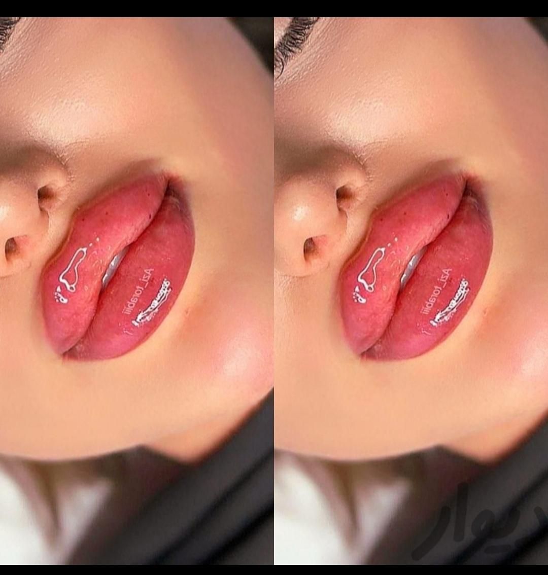 فیلر چانه گونه زاویه بوتاکس هایفو ژل ساکشن غبغب نخ|خدمات آرایشگری و زیبایی|مشهد, فرهنگ|دیوار