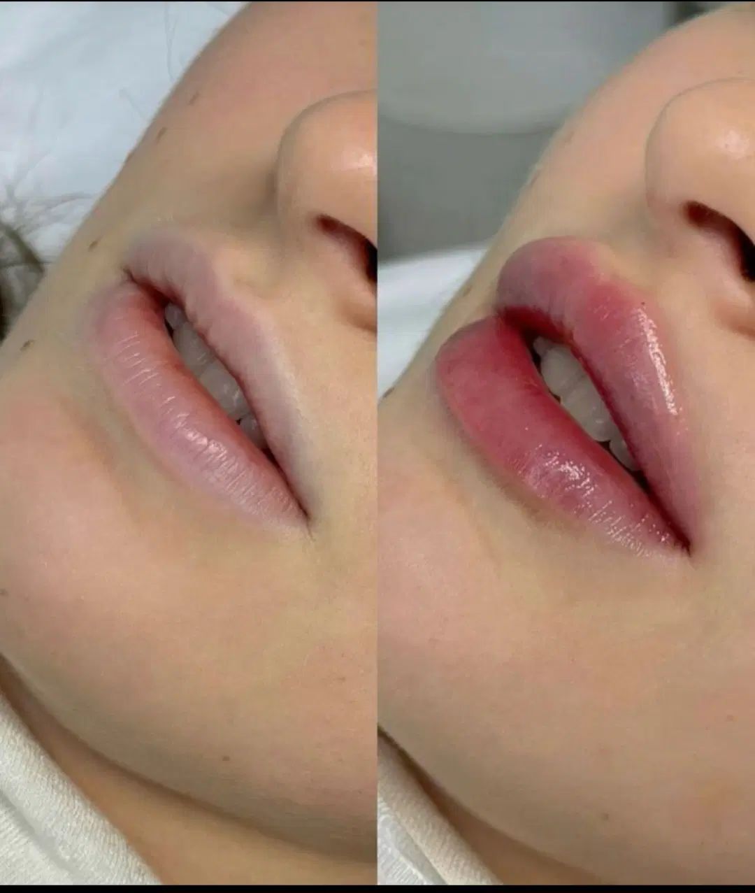 ژل و بوتاکس فیلر چربی مزو|خدمات آرایشگری و زیبایی|مشهد, طلاب|دیوار
