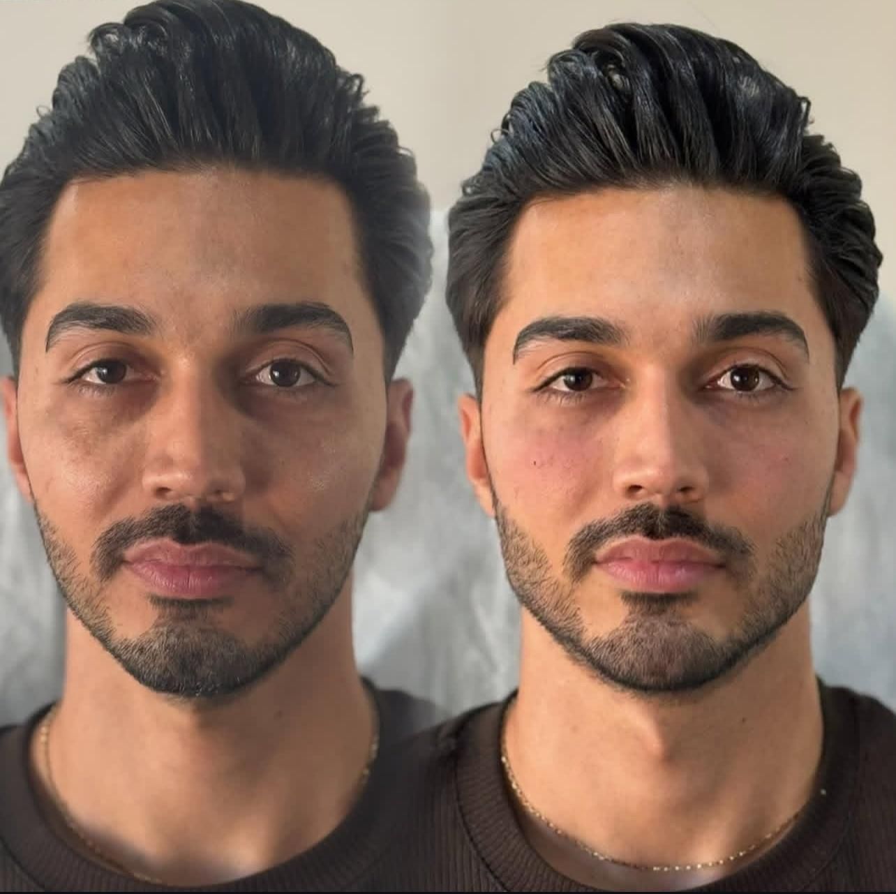 تزریق ژل لب،گونه،زاویه فک ،چانه،بوتاکس و فیلر بدن|خدمات آرایشگری و زیبایی|کرج, فاز ۱ مهرشهر|دیوار