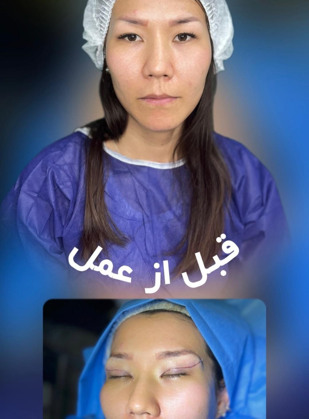 بلفاروپلاستی،سانترال لب،ساکشن غبغب،ساکشن بدن|خدمات آرایشگری و زیبایی|کرج, گوهردشت|دیوار