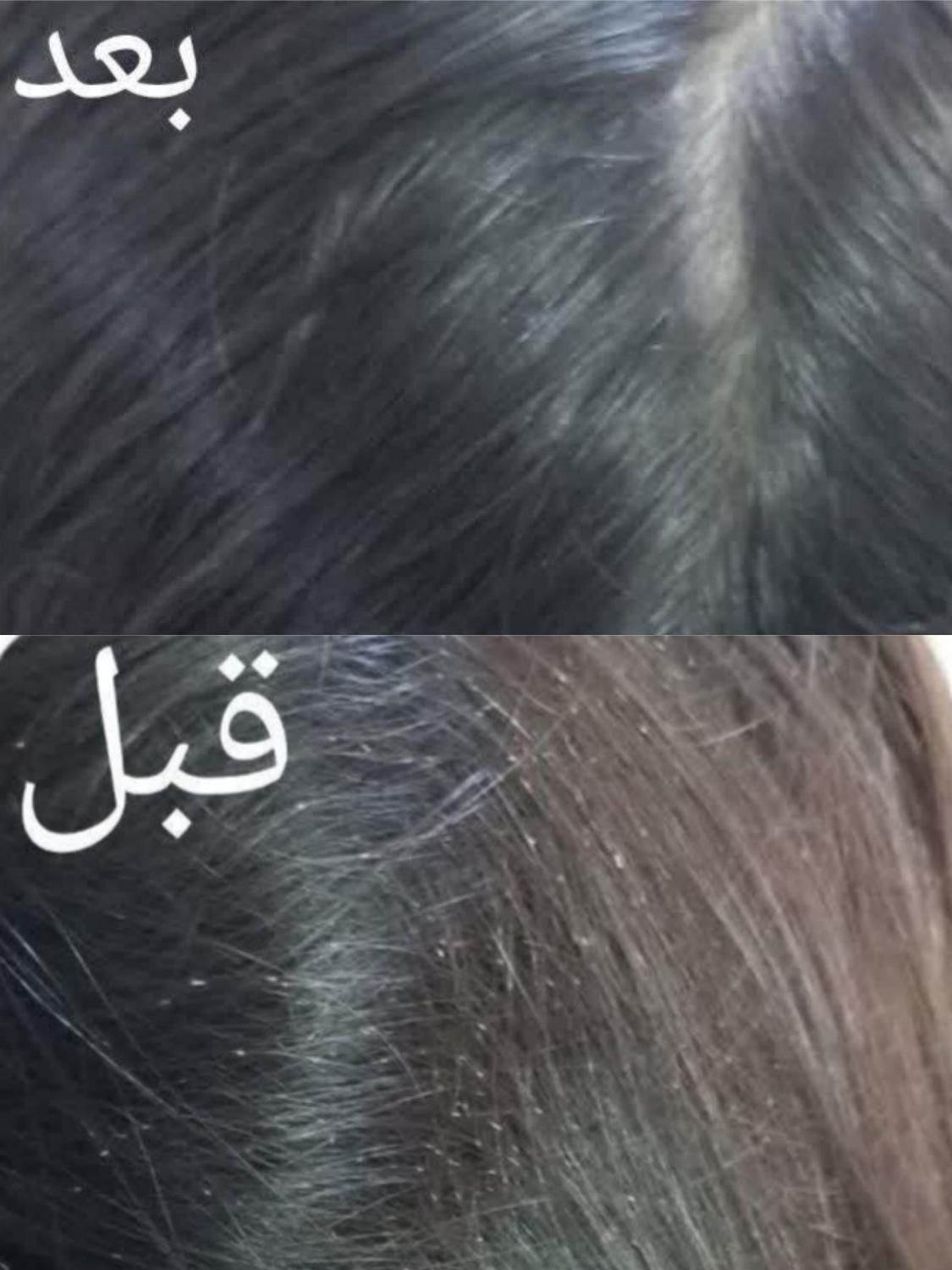 پاکسازی شپش باموادصددرصد گیاهی و تضمینی|خدمات آرایشگری و زیبایی|قم, نیروگاه|دیوار