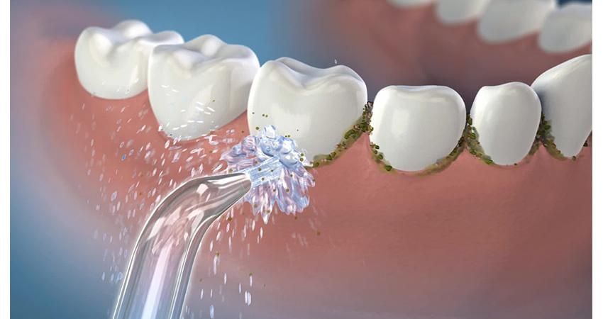 واترجت دندان شارژی ارتودنسی کامپوزیت ایمپلنت|آرایشی، بهداشتی، درمانی|تبریز, |دیوار